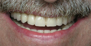 Зубные протезы