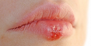 герперс на губах