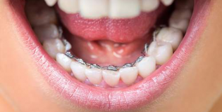Незаметные брекеты