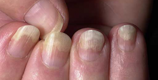 Псориаз ногтей