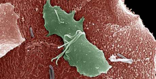 трихомониаз