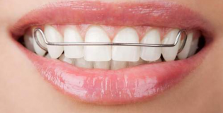 Ретенционные аппараты 