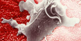 трихомониаз