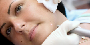 Удаление папиллом лазером