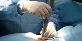 Лазерная вапоризация