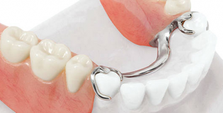 Бюгельный протез