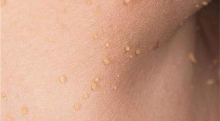 Папилломы на шее