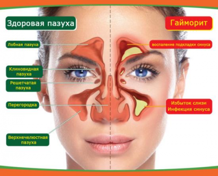 гайморит гайморит