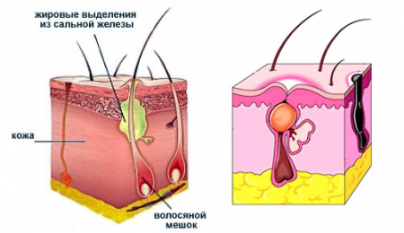 Строение фурункула Строение фурункула